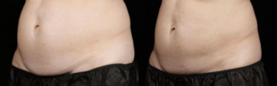 a person's stomach before & after SculpSure