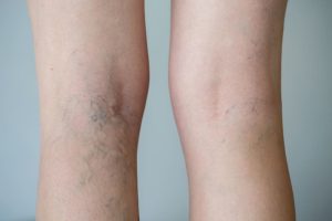 spider veins on the backs of legs
